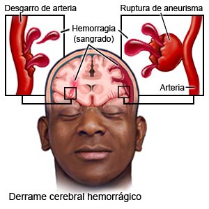 Todo lo que debes saber acerca de los derrames cerebrales ...
